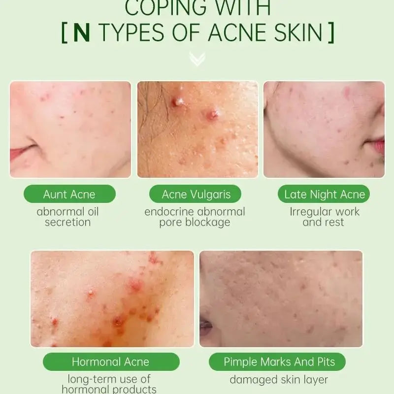 TEA TREE - Serum Acne Removal